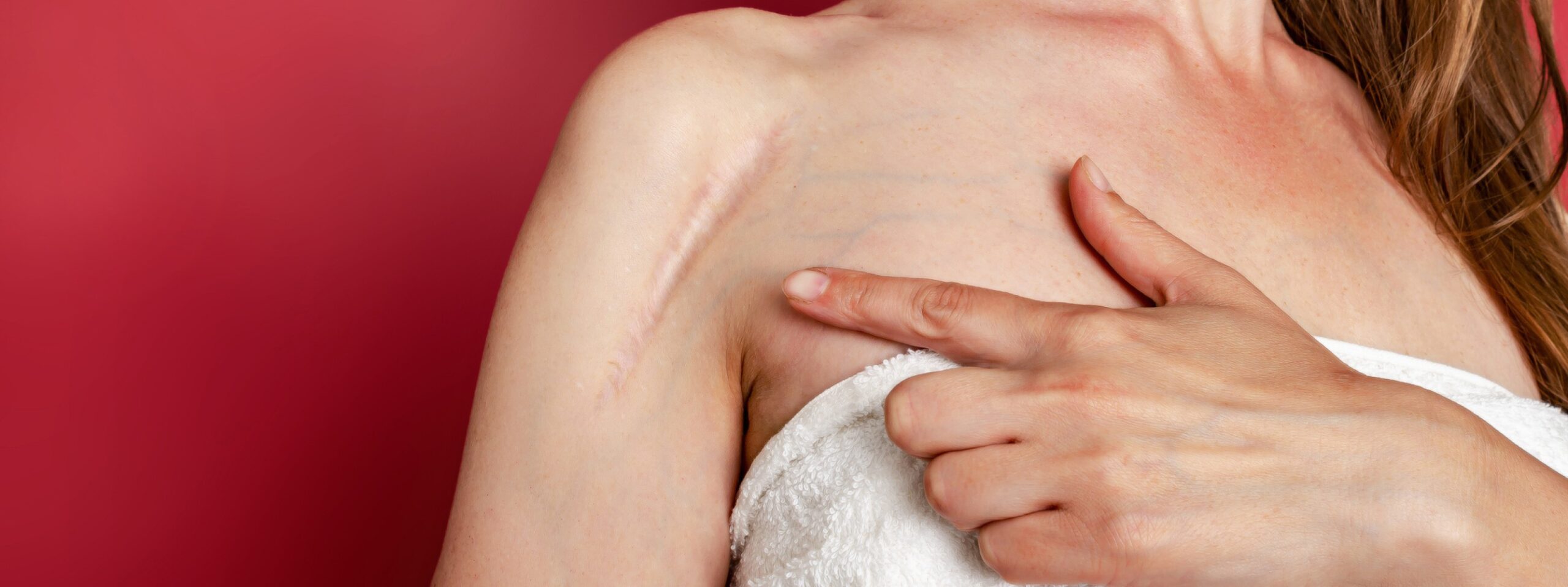 Les techniques de médecine esthétique pour supprimer les cicatrices | Dr Stéphanie Cordier | Bois-Guillaume